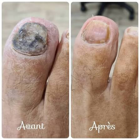 Sérum Mycose Des Ongles.