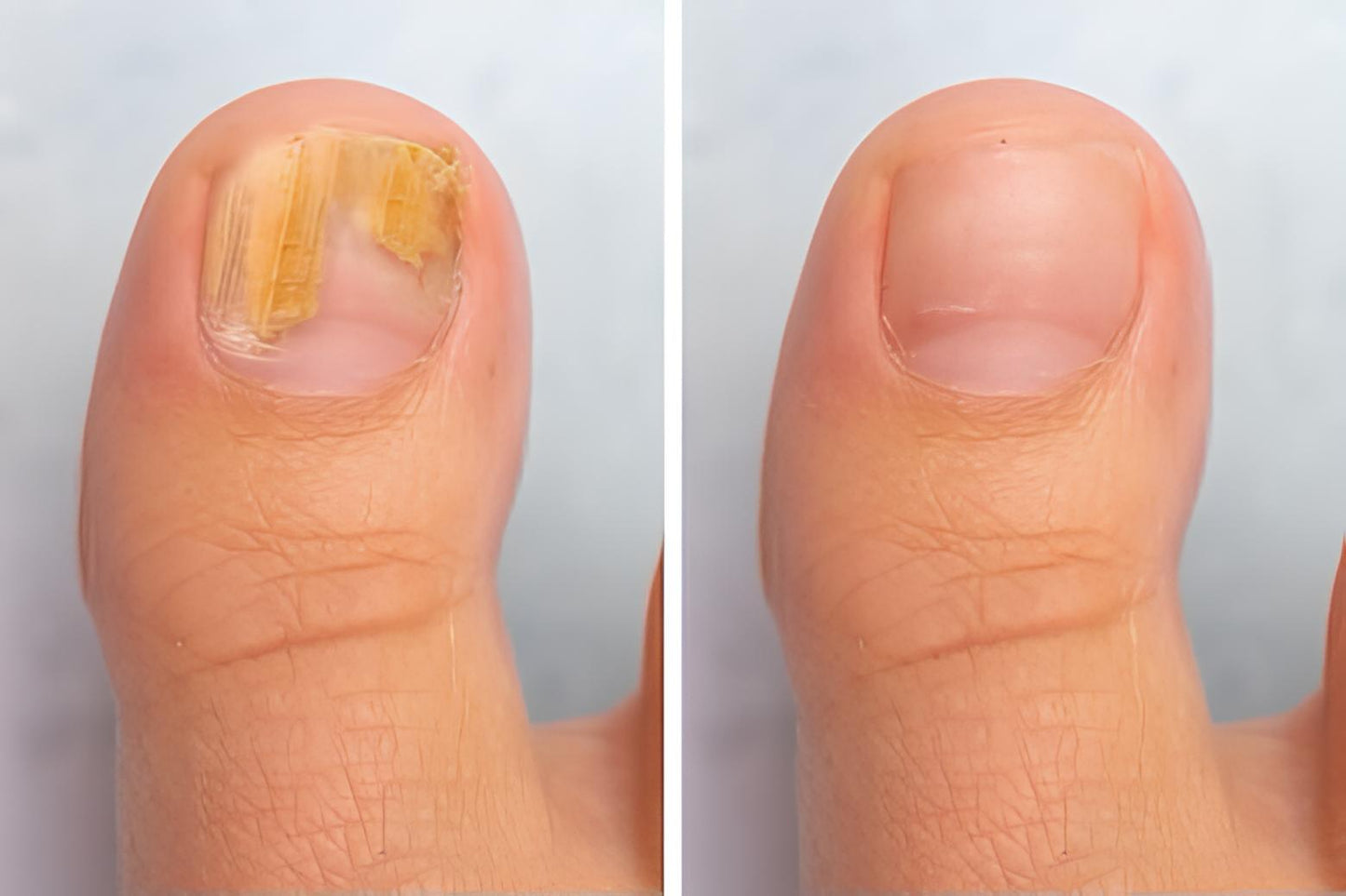 Sérum Mycose Des Ongles.